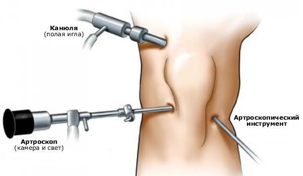 Artroscopie van het kniegewricht