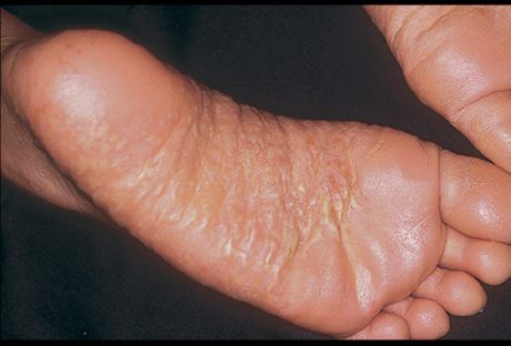 Dermatitis van benen en de oorzaken ervan