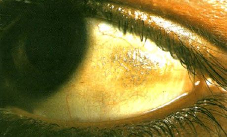 Xerophthalmie.  Bito's plaques zien er verheven uit, met de depositie van meerdere schalen, conjunctiva-plaatsen in een zone die niet door oogleden wordt bedekt.  Zoals in dit geval zijn pathologische gebieden vaak gepigmenteerd.