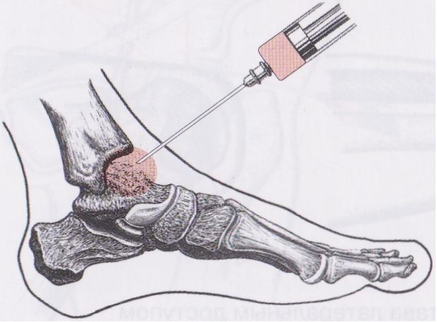 Het probleem van optimale behandeling van artritis