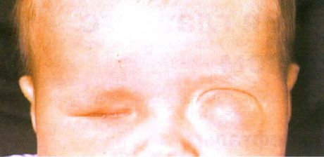 Microfthalmus met gelijktijdige cyste-vorming (linkeroog).  Anophthalmus (rechteroog).