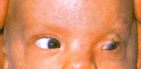 Fraser-syndroom.  Onvolledige cryptophthalmus van het linker oog.