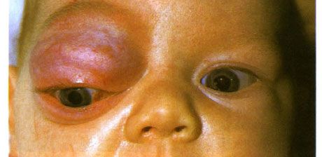 Capillair hemangioom van het voorste deel van de baan en het bovenste ooglid.  Neoplasma heeft de neiging vooruit te gaan