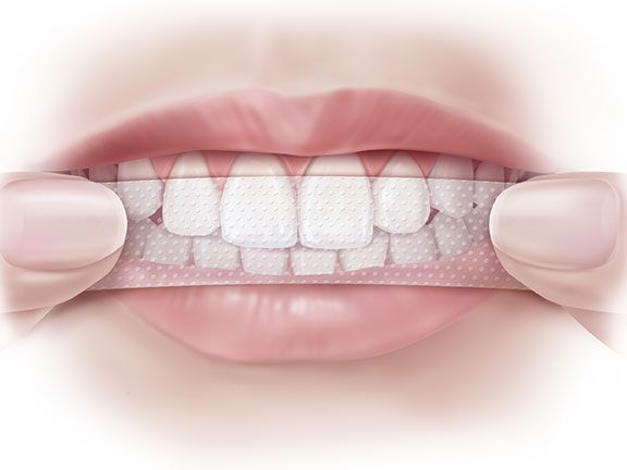 Hoe whitening strips voor tanden te gebruiken?