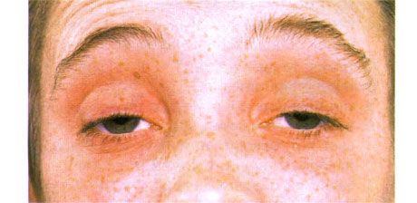 Externe oftalmoplegie.  Dubbelzijdige ptosis.  De patiënt opent zijn ogen door zijn wenkbrauwen op te trekken