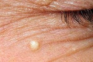 Atheroma op het gezicht: symptomen, behandeling
