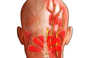 Невропатия затылочного. Ущемление затылочногоинерва. Защемление затылочного нерва. Заболевания малого затылочного нерва.