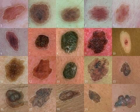 Wetenschappers hebben een gen gevonden dat een centrale rol speelt in de ontwikkeling van melanoom