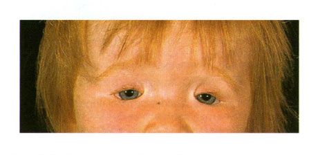 Dubbelzijdig coloboom van de oogleden bij een kind met het syndroom van Golden.  Sluiting van de ooggleuf aan de linkerkant